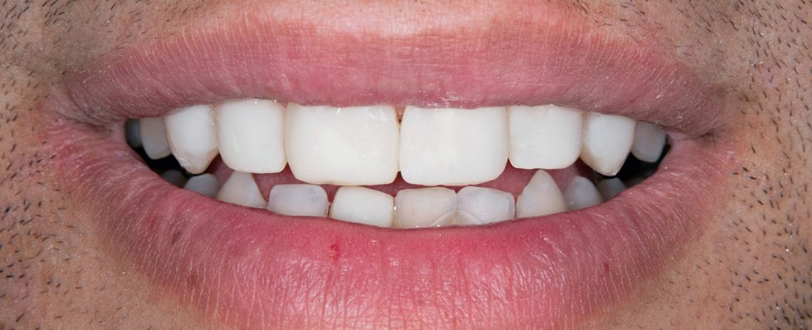Veneers After